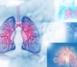 Ülkemizde En Sık Görülen Akciğer Kanseri